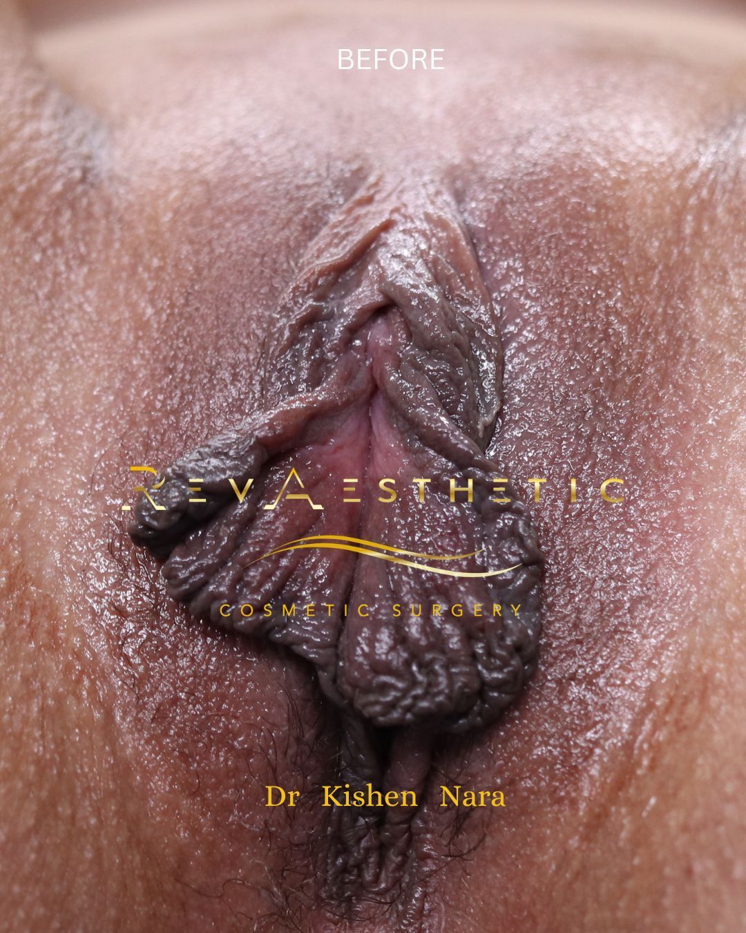 SAP labiaplasty — before